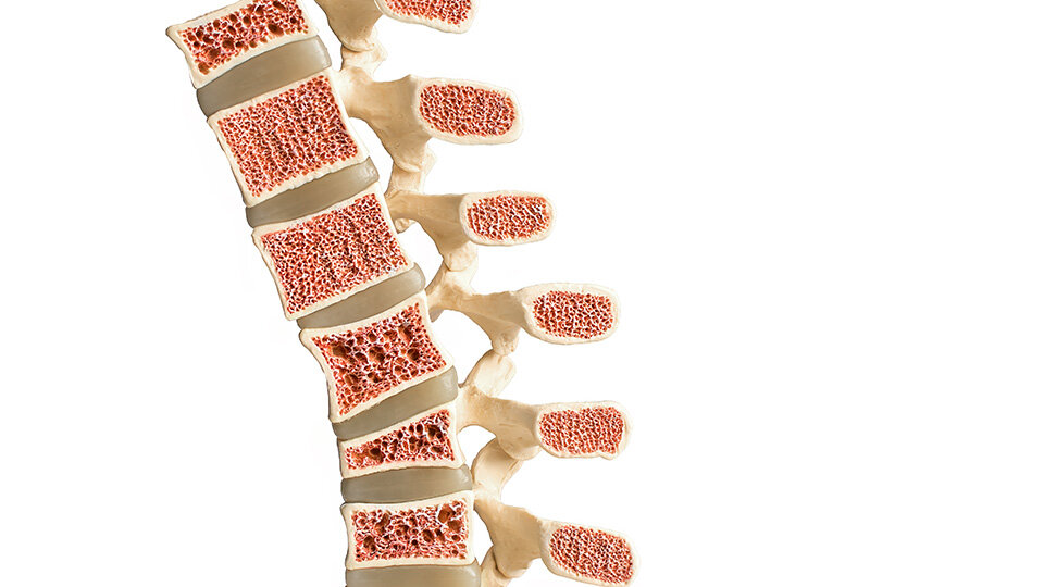New Study Reveals Key Protein that Could Help Prevent Excessive Bone Loss in Osteoporosis
