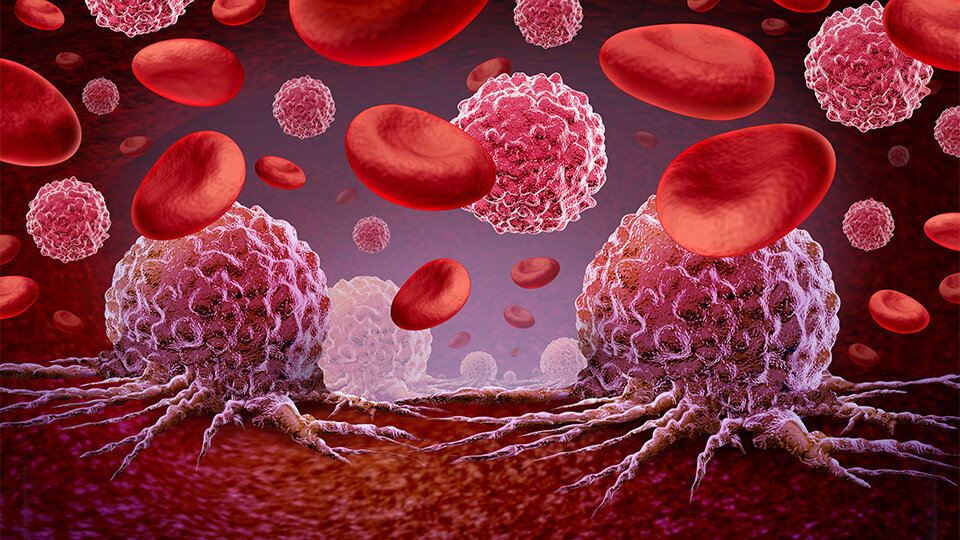 How Inflammation Drives Bone Loss in an Aggressive Childhood Leukemia