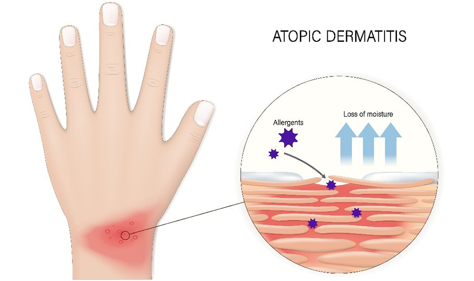 Study Reveals a Critical Immune Pathway Involved in Systemic Allergy