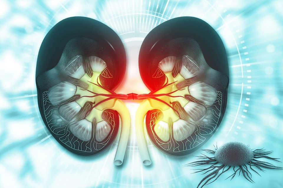 Gene Expression Linked to Survival Differs by Kidney Cancer Subtype